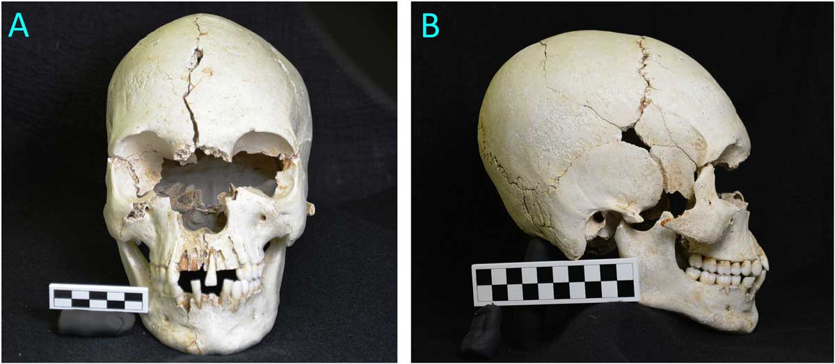 Skeleton found in Caribbean Island shows sign of leprosy